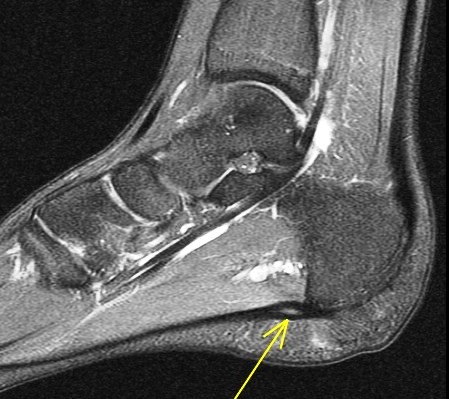 Figure 5 for case Juvenile plantar fibromatosis